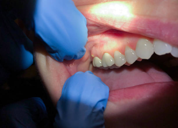 Best Broken or Cracked Tooth Emergency Dentist in Bright, IN