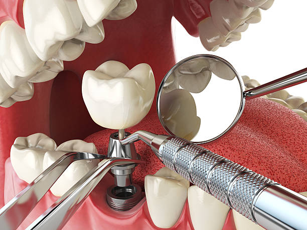 Best Emergency Root Canal Treatment in Bright, IN